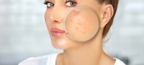 acne scar treatment in Haldwani