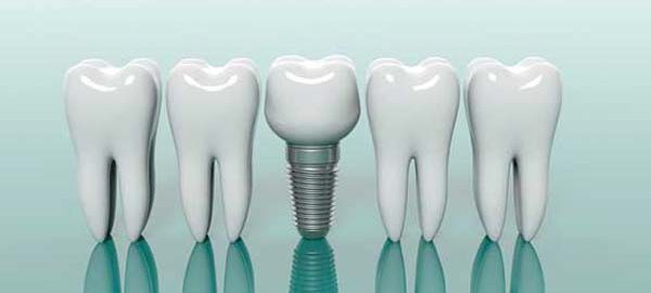 dental implant in Haldwani