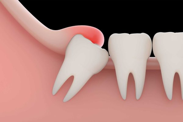 Wisdom Tooth Extraction in Haldwani