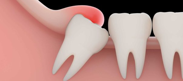 Wisdom Tooth Extraction in Haldwani